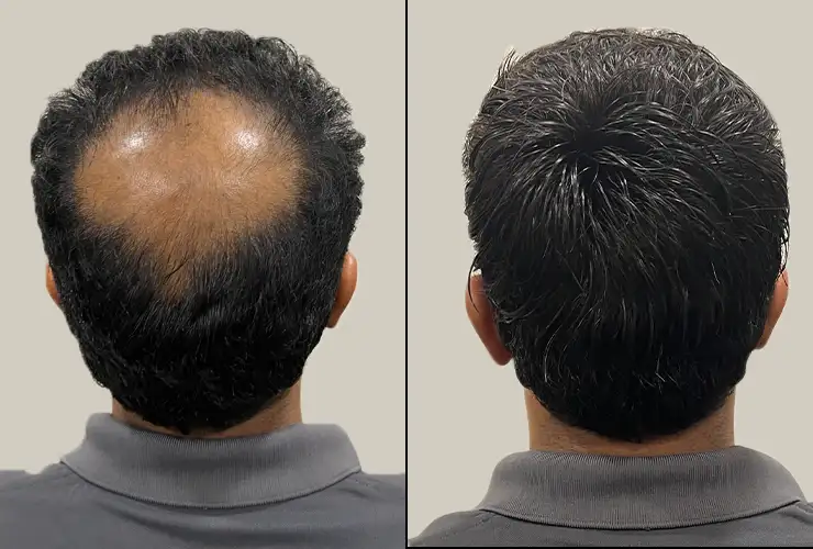 Crown Hair Patch| Hair N Care