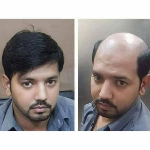 Crown Hair Patch| Hair N Care - Image 2